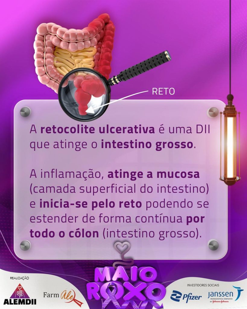 Informações sobre a Retocolite Ulcerativa Alemdii