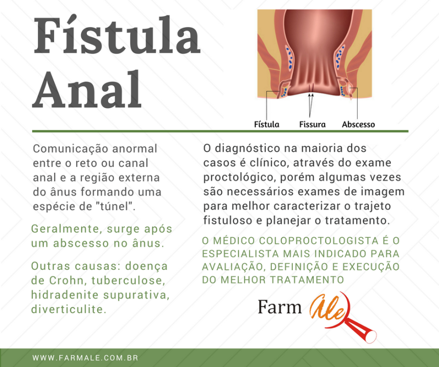 Fístula Anal