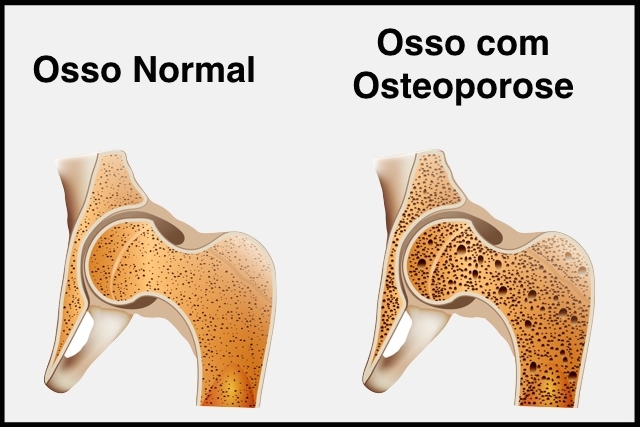 Armas contra a osteoporose