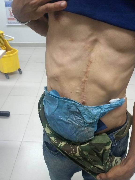 Faltam bolsas para ostomias em Pernambuco