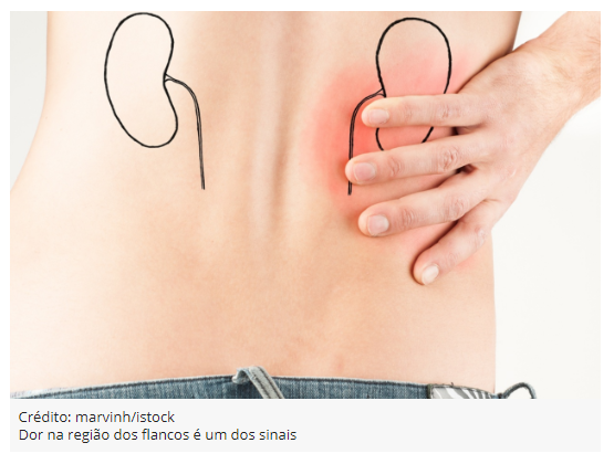 Cuidados que você deve ter para evitar pedra nos rins