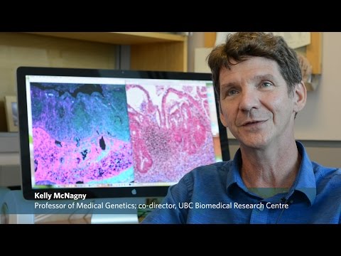 Descoberta mutação que pode ser útil para doentes de Crohn