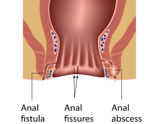 Fístula anal remédios