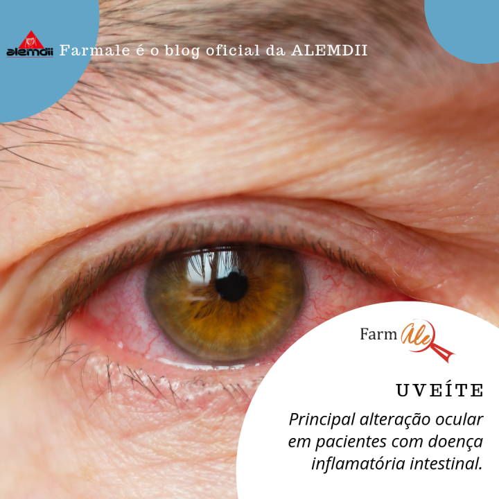 Uveíte na doença inflamatória intestinal