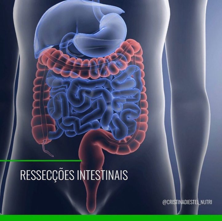 Ressecção Intestinal