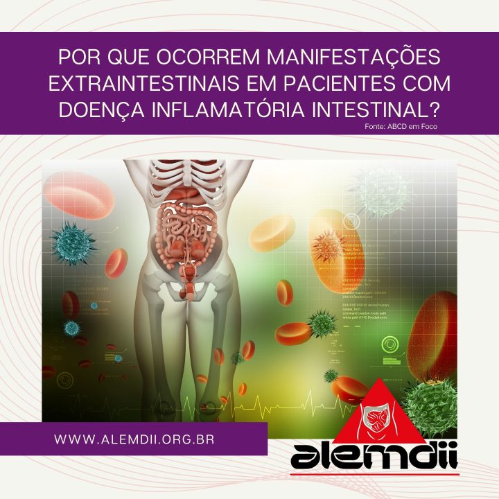 Por Que Ocorrem Manifestações Extraintestinais em Pacientes com Doença Inflamatória Intestinal?